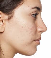 acne-sushaanth-sushaanth-homeopathy-clinic-chennai
