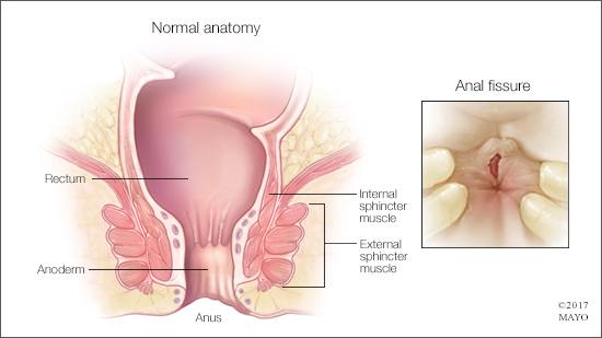 annual-fissure-sushaanth-sushaanth-homeopathy-clinic-chennai