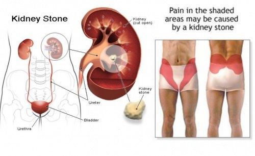 kidney stone 4
