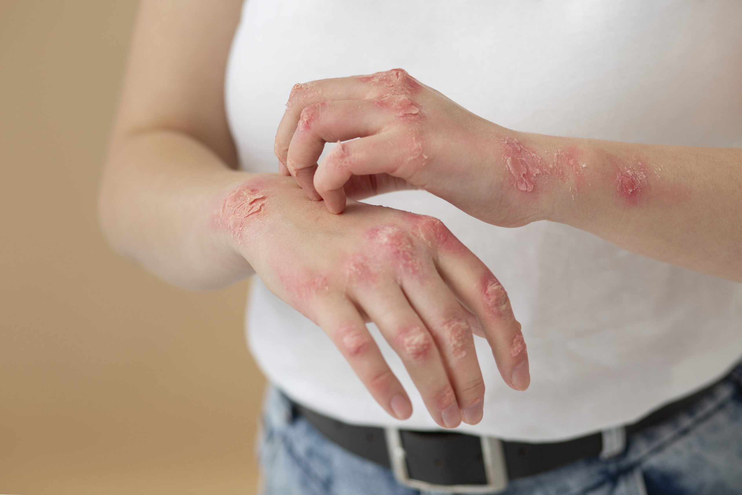 Psoriasis Treatment in Homeopathy